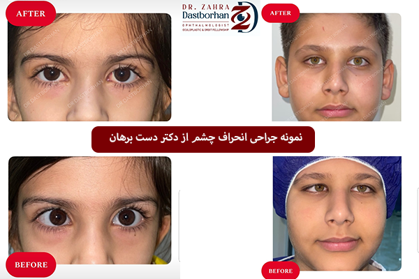 جراحی انحراف چشم در کودکان