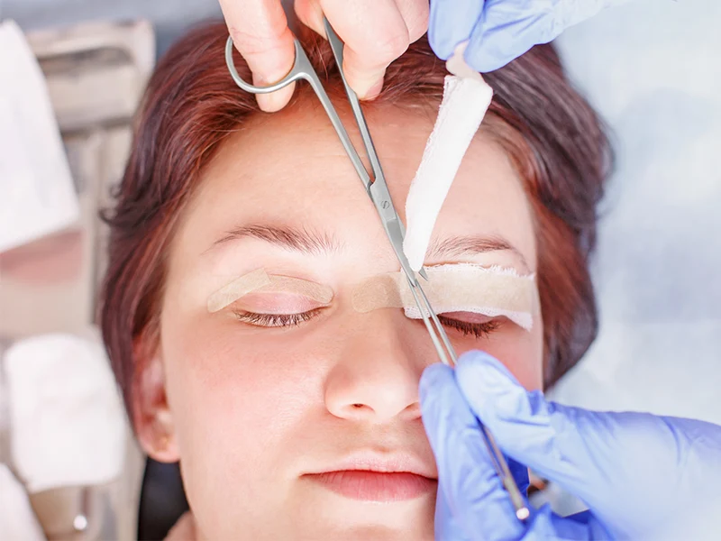 بلفاروپلاستی