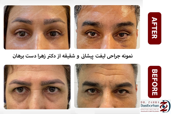 لیفت پیشانی و شقیقه