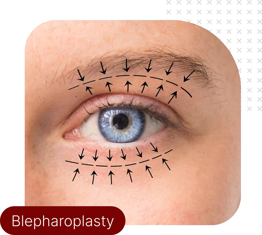 بلفاروپلاستی