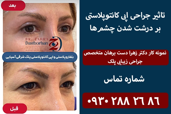 نمونه کار اپی کانتوپلاستی دکتر دست برهان
