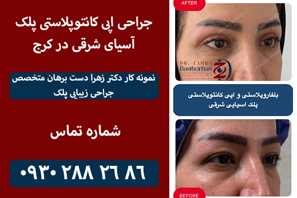 اپی کانتوپلاستی پلک آسیای شرقی در کرج