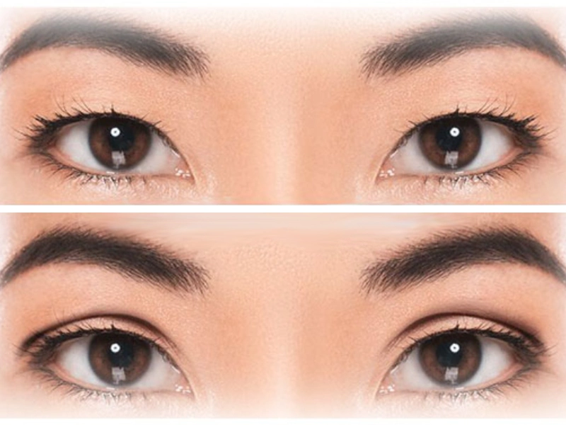 جراحی اپی کانتوپلاستی