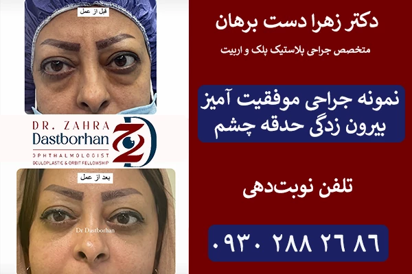 درمان بیرون زدگی چشم با جراحی حدقه چشم