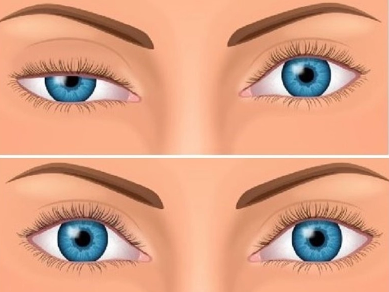 جراحی پتوز پلک در کرج