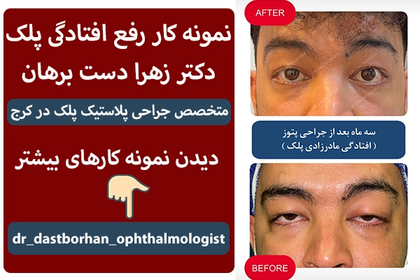 رفع افتادگی پلک توسط دکتر دست برهان در کرج