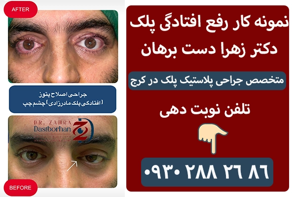 نمونه کار جراحی پتوز دکتر زهرا دست برهان در کرج