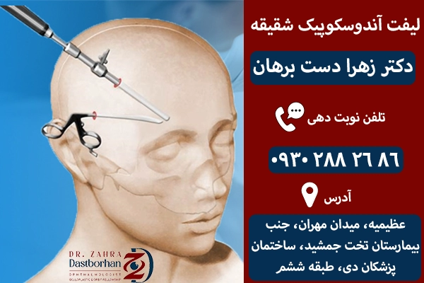 لیفت آندوسکوپیک شقیقه