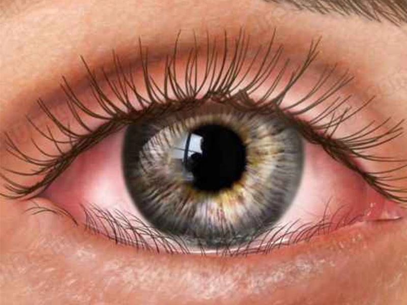 درمان انتروپیون