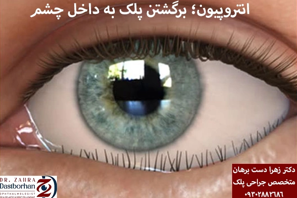 برگشتگی پلک به داخل چشم