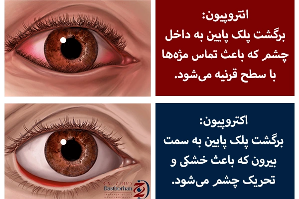 تفاوت انتروپیون و اکتروپیون