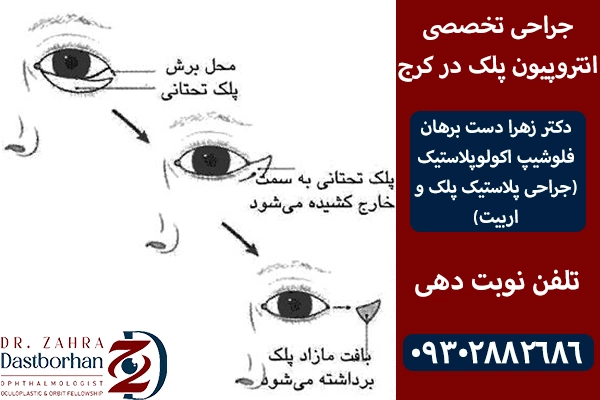 جراحی انتروپیون پلک