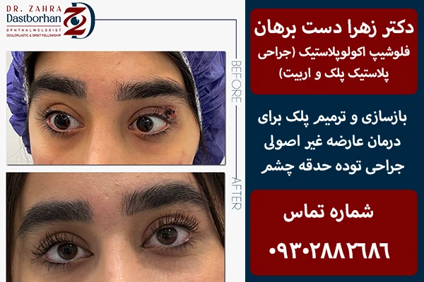عمل ترمیمی پلک و بازسازی پلک