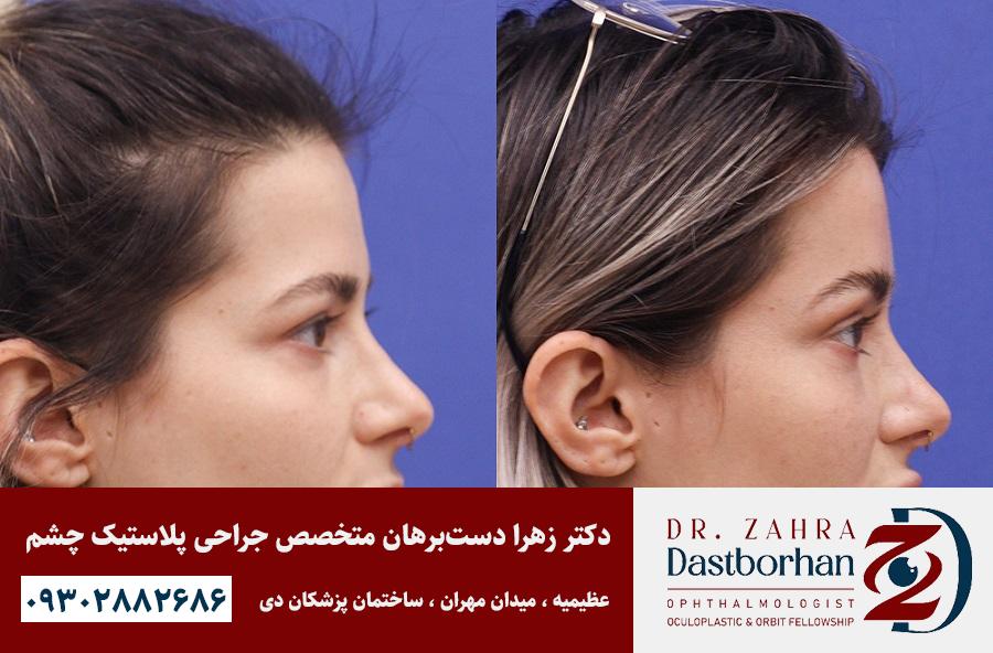 لیفت شقیقه بهتر است یا بوتاکس؟