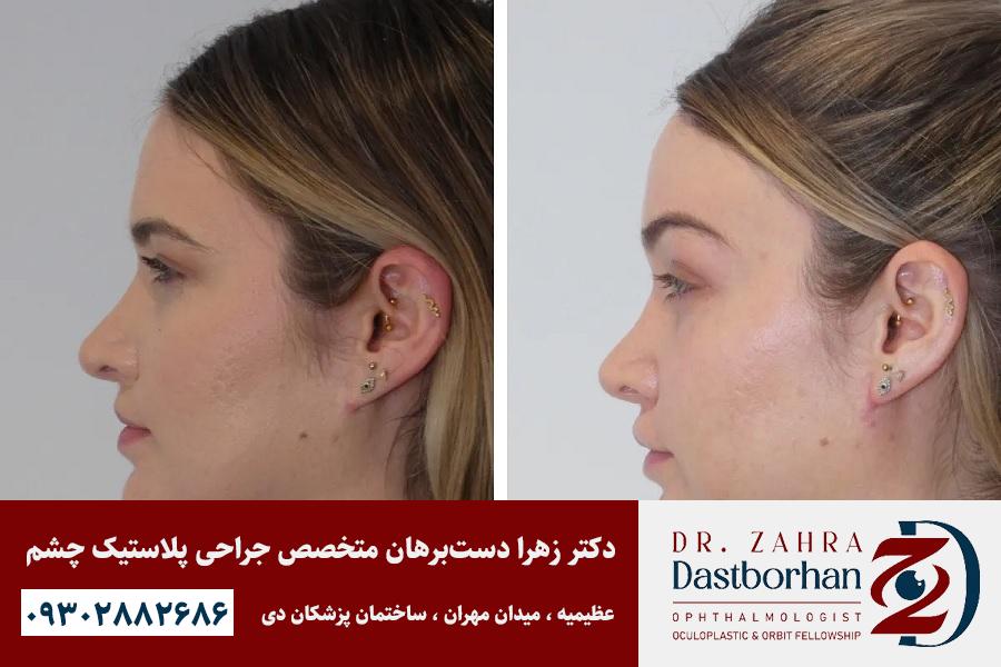 لیفت شقیقه بهتر است یا بوتاکس؟