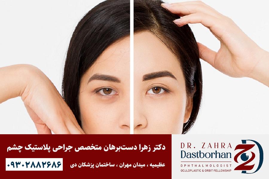 لیفت پیشانی