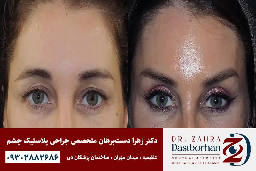 لیفت شقیقه بهتر است یا بوتاکس؟