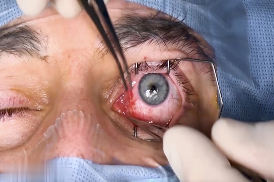 جراحی انحراف چشم