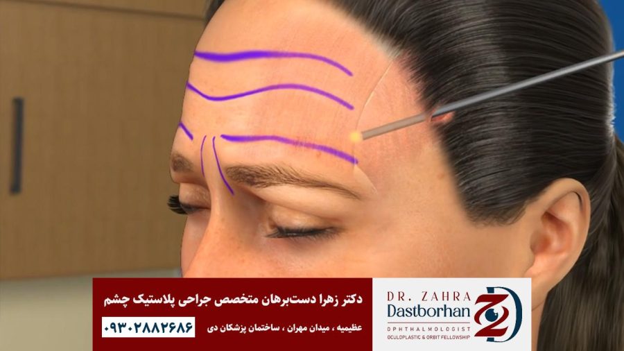 لیفت پیشانی