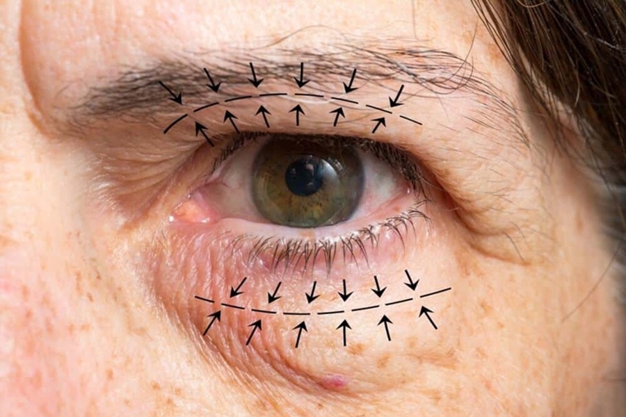 جراحی پلک با تکنیک‌های نوین و کم‌تهاجمی