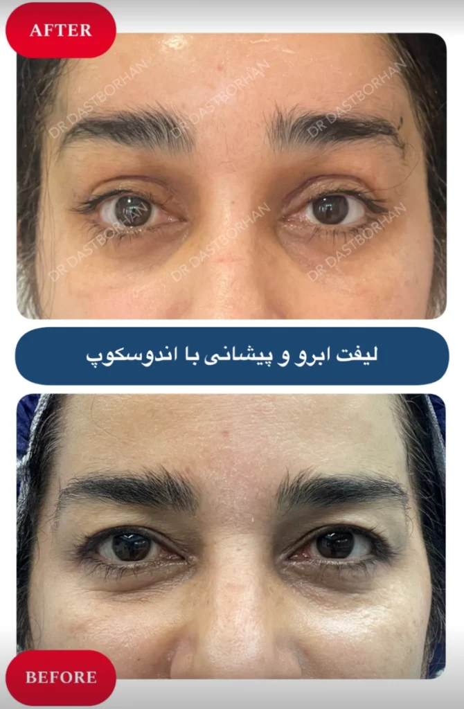 لیفت اندوسکوپیک پیشانی دکتر زهرا دست برهان