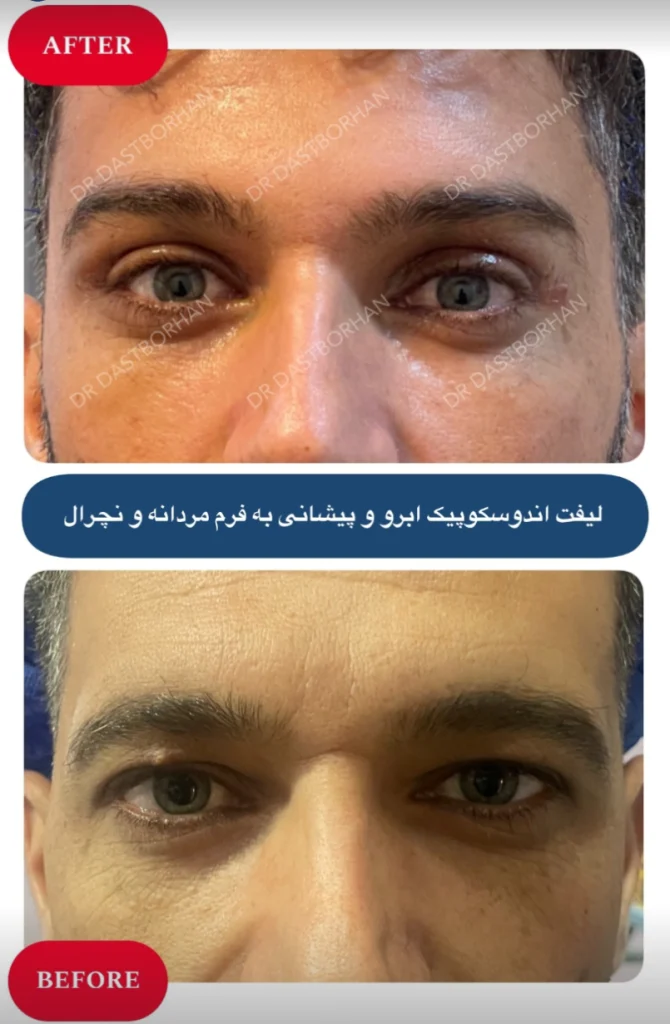 عکس قبل و بعد لیفت پیشانی