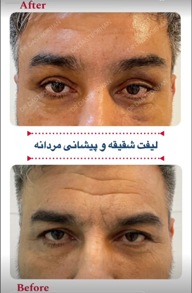 لیفت پیشانی دکتر زهرا دست برهان