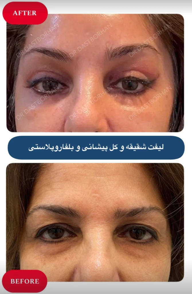 لیفت شقیقه و پیشانی همزمان با بلفاروپلاستی در کرج