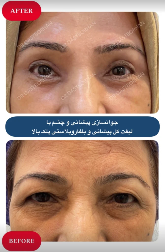 لیفت شقیقه و پیشانی همزمان با بلفاروپلاستی در کرج