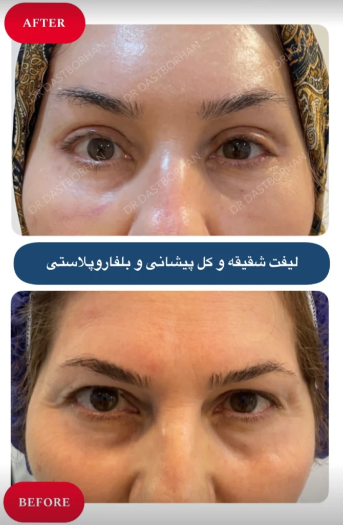 لیفت شقیقه و پیشانی همزمان با بلفاروپلاستی در کرج