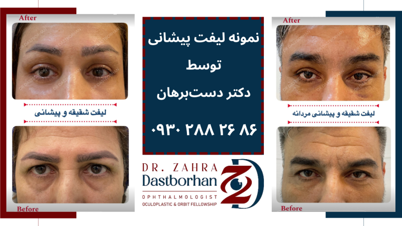 لیفت اندوسکوپیک پیشانی در کرج
