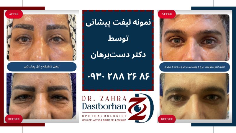 لیفت پیشانی در کرج