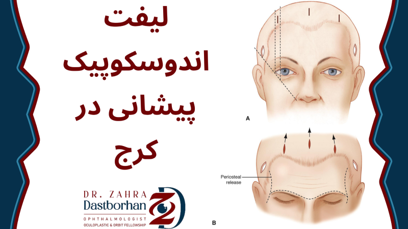 لیفت اندوسکوپیک پیشانی