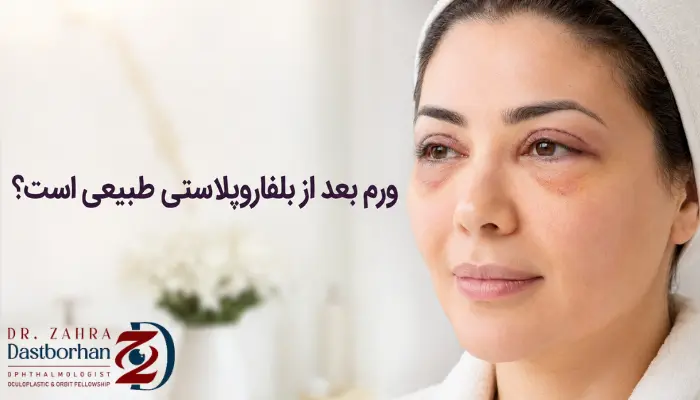 ورم بعد از بلفاروپلاستی طبیعی است؟