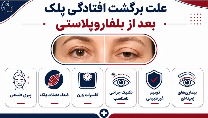 علت برگشت افتادگی پلک بعد از بلفاروپلاستی چیست؟